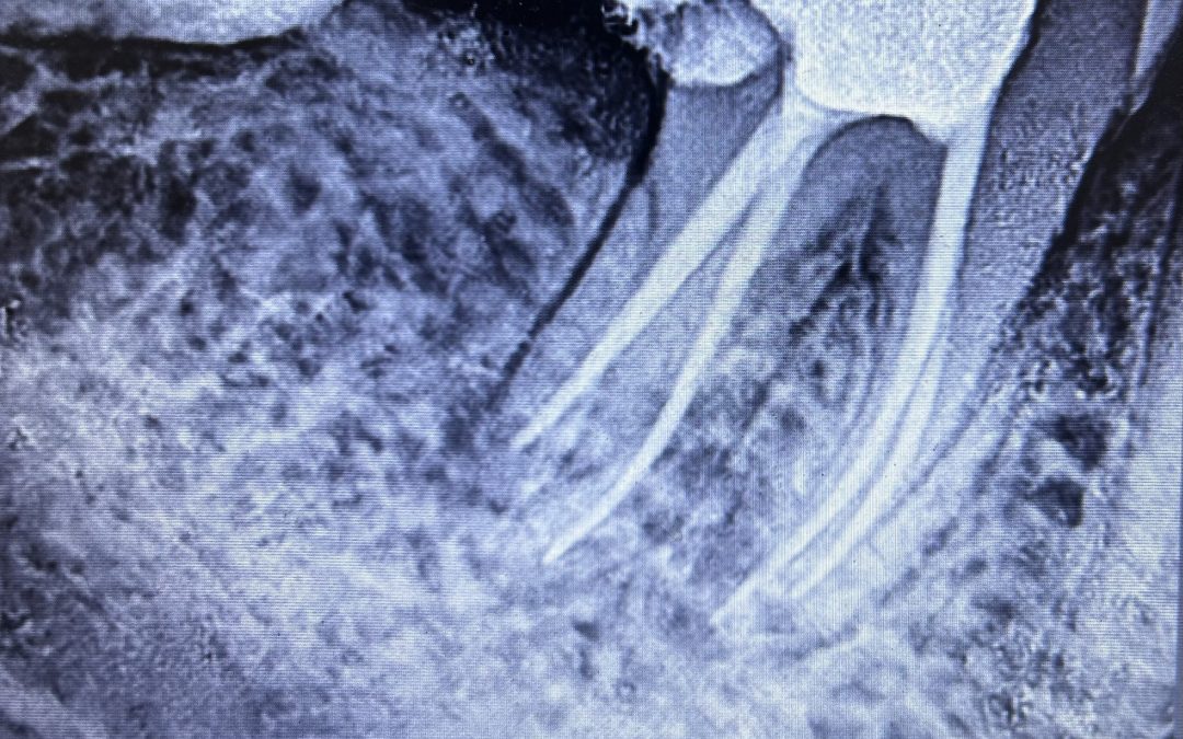 Saving a Severely Infected Tooth – The Story of a Pain-Free Future